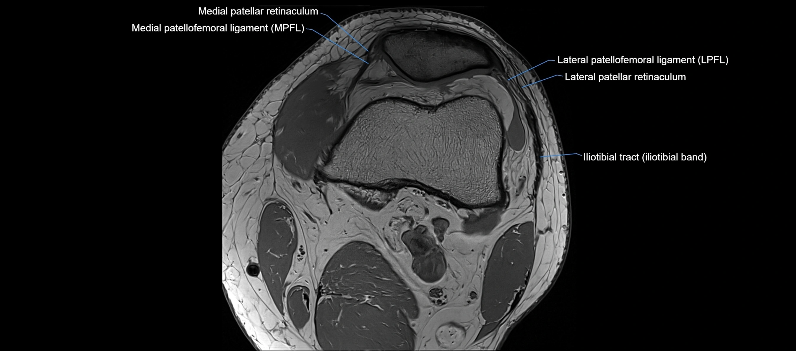 MRI Knee axial  ligaments cross sectional anatomy 3T  radiology  image-img-03001-00011.webp